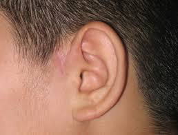 先天性耳前瘘管的治疗方法