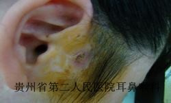 耳前瘘管是什么样的疾病