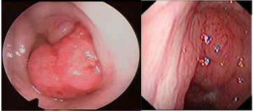 “透明微创术”治疗白癜风一步到位