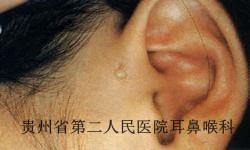 先天性耳前瘘管有哪些注意事项