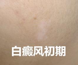 白点的症状哪些