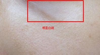 白癜风有什么症状