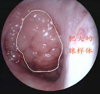 白癜风的最好的治疗方法是什么