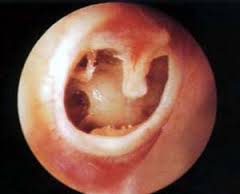 白癜风是怎么引起的