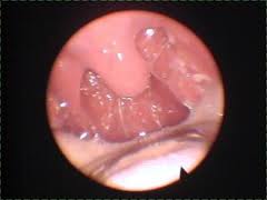 白癜风最主要的病因是什么