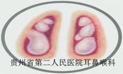 贵阳白癜风要注意哪些问题