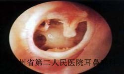 白癜风的三大症状是什么