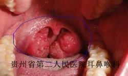 导致白癜风的因素是什么