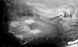 白癜风常有哪些症状表现