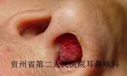 贵阳肥厚性白癜风的症状有哪些