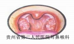 白癜风是怎么引起的