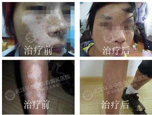 国际白癜风临床治疗最先进技术——【白癜风】Recell细胞再生术 国际白癜风临床治疗最先进技术——【白癜风】Recell细胞再生术