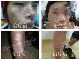 白癜风治疗方法 白癜风治疗方法