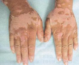 散发型白癜风的病因有哪些