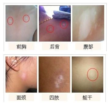白癜风有哪些特征