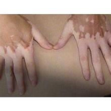 手部的白癜风能治好吗