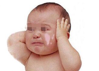 儿童白癜风如何预防