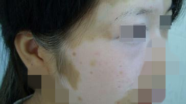 面部白癜风有哪些表现