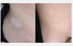 颈部白癜风的常见病因都有哪些