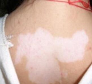 背部白癜风有什么症状