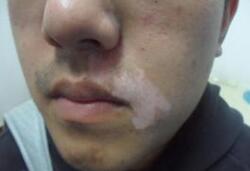 怎么治疗嘴角白癜风呢