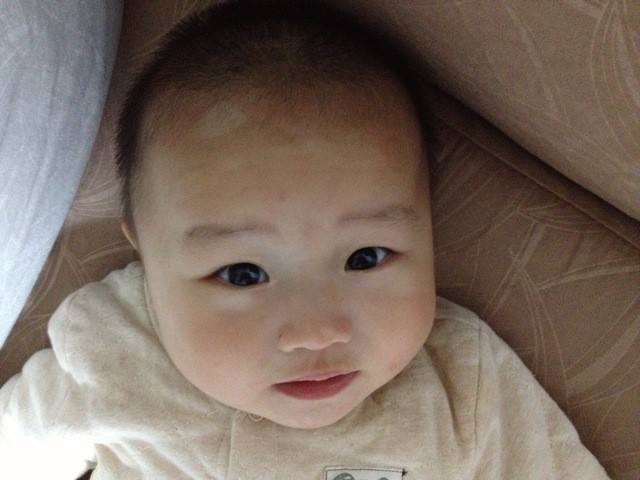 白癜风白斑好转时的症状表现