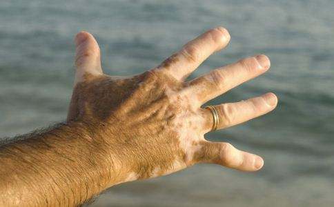 治疗白癜风是一件不容忽视的事