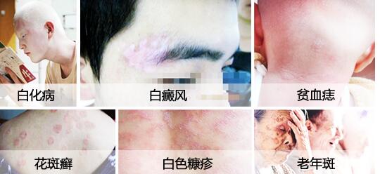 白癜风带来很大困扰, 科学诊断带你远离它