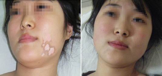 白癜风反反复复实在让人头疼