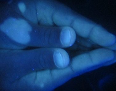 夏季白癜风高发,诊断护理尤为关键