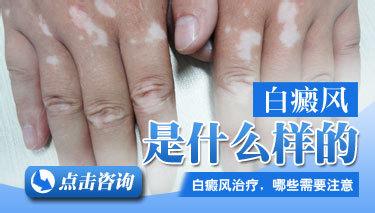 从症状入手了解白癜风,从生活入手抑制白癜风