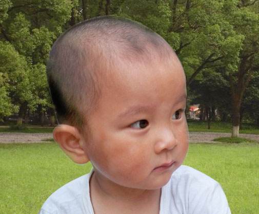 治白癜风吃着药呢为什么还越来越多