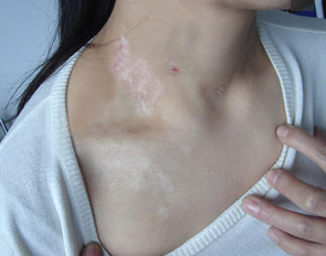 患了白癜风会有哪些危害