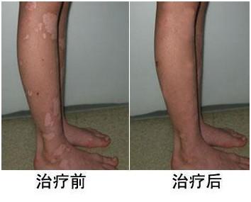 这样做有效激活黑色素生长,让白斑复色更快