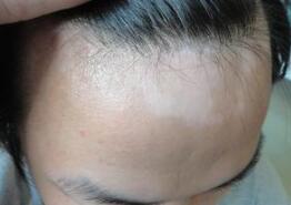 早期白癜风是白癜风恢复效果好