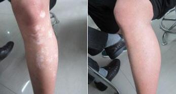 白癜风辅助治疗方法有哪些?