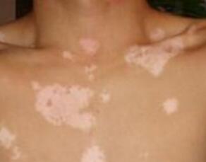 白癜风病变的面积会逐渐扩大吗?外用药品适合吗?