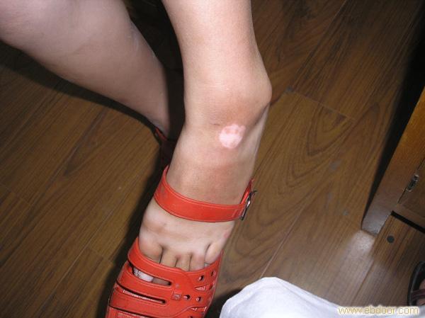 白癜风皮损发红怎么回事?怎么处理呢