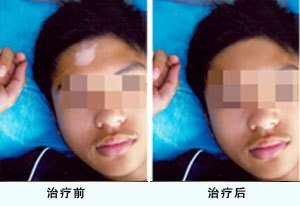 患有白癜风的青少年后不能吃什么