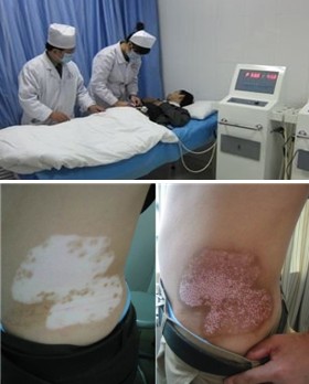 究竟是什么会让白斑久治不愈