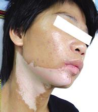 治好白癜风回家过年,你还来得及!