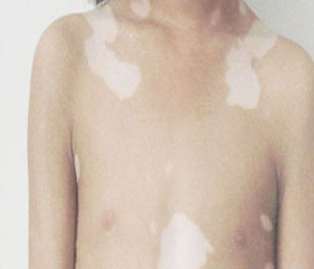 白癜风针对治疗会有更好的疗效