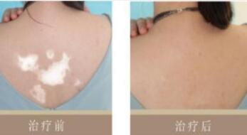 别一时大意,让白癜风钻空子!