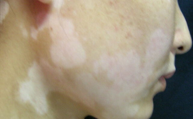 治疗儿童白癜风怎样才能让家长放心