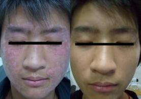 脸上长了白癜风要怎么正确对待?