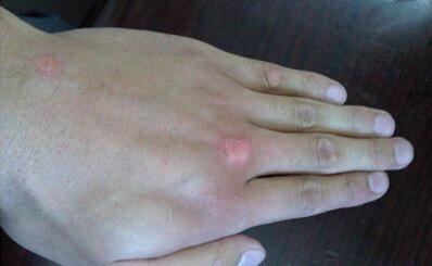 白癜风医治期间哪些行为要杜绝