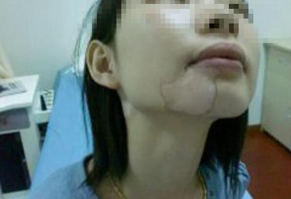 白癜风不痛不痒为什么要治疗?