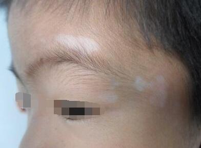 孩子治疗白癜风,会影响孩子成长发育吗?