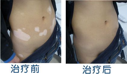 武汉治疗白殿疯选择环亚医院