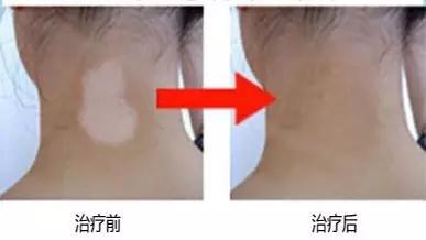 外用药很难治好白癜风?标本兼治才管用
